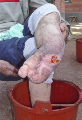 Behandlung eines Leprakranken