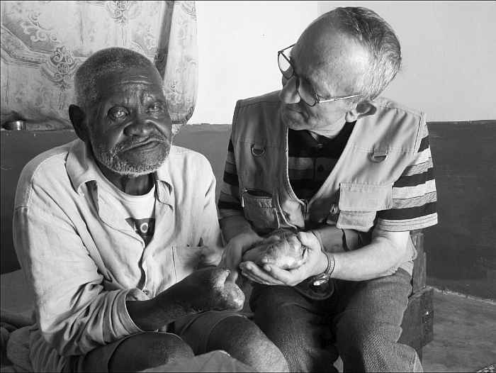 zum Projektbericht Leprakranker mit verstümmelten Händen