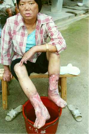 "... ausgesetzt. Lepra in China. Kamillianer heilen Wunden."