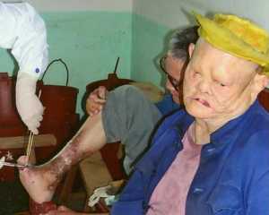 von Lepra entstellt...